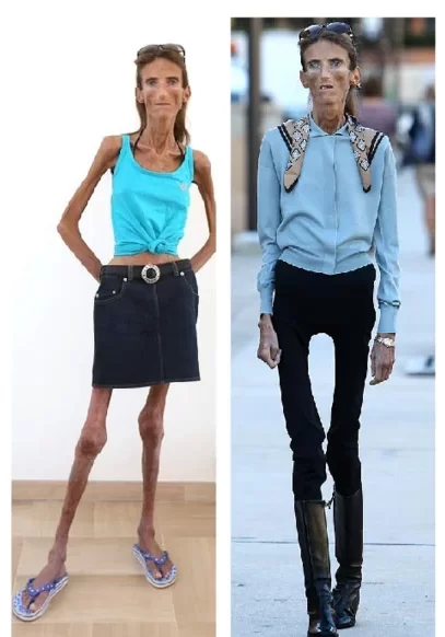 the skinniest person in the world guinness world record