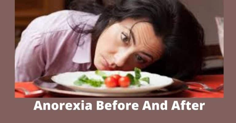 Anorexia Before And After