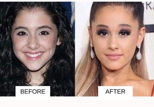 Ariana_Grande before and after surgery