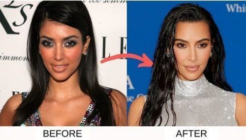Kim Kardashian before and after surgery