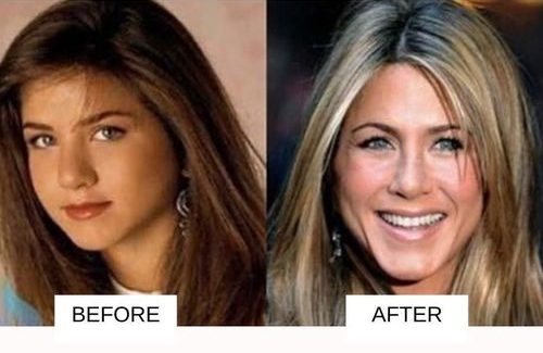 Jennifer_Aniston before and after surgery